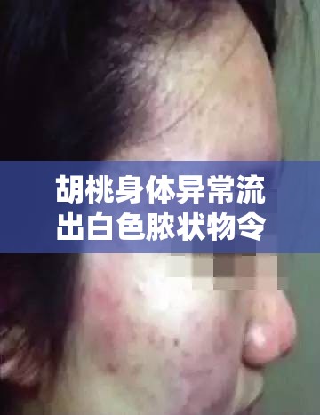 胡桃身体异常流出白色脓状物令人担忧